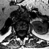 Axial opposed-phase T1 MR shows a loss of signal in both adenomas, confirming the presence of lipid.