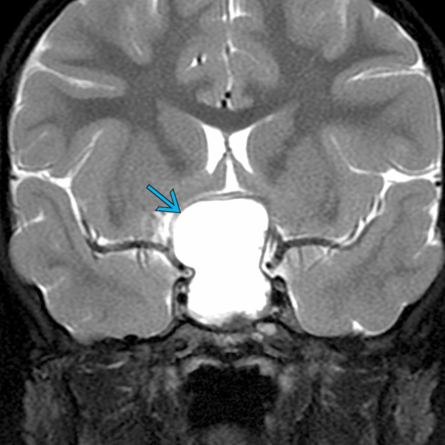 Coronal T2 FS MR in a 7-year-old child with delayed growth shows a hyperintense suprasellar mass
related to an adamantinomatous craniopharyngioma. These tumors are known as the 90% tumor, as 90% are cystic, calcified, and enhancing.
