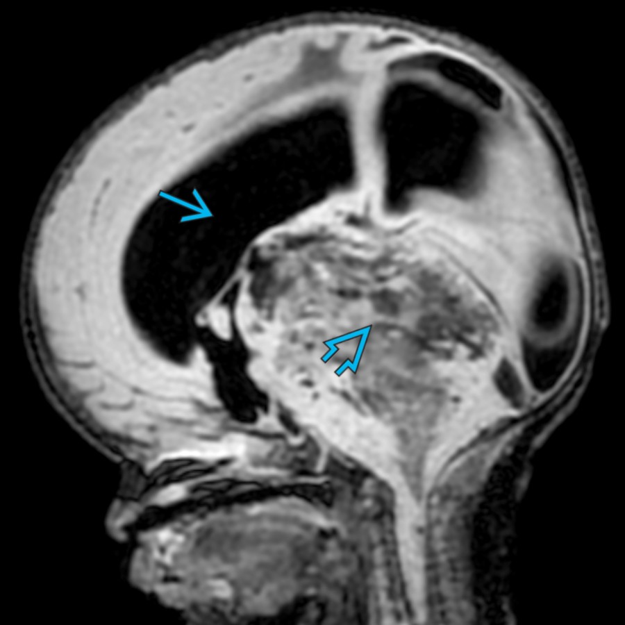 Sagittal FLAIR MR in a neonate with a large, obstructing, hemorrhagic posterior fossa mass
shows enlargement of the lateral ventricles
& posterior fossa. Note the ↑ craniofacial ratio.