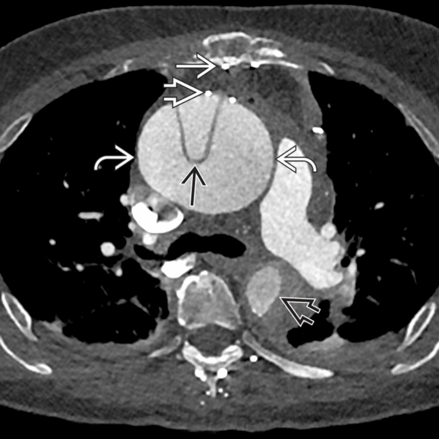 CTA in a woman in her 80's with a distant history of coronary artery bypass grafting (CABG) presents with several days of chest pain confirms median sternotomy
and post CABG changes
. The ascending aorta is aneurysmal
with dissection involving both the ascending
and descending
thoracic aorta.