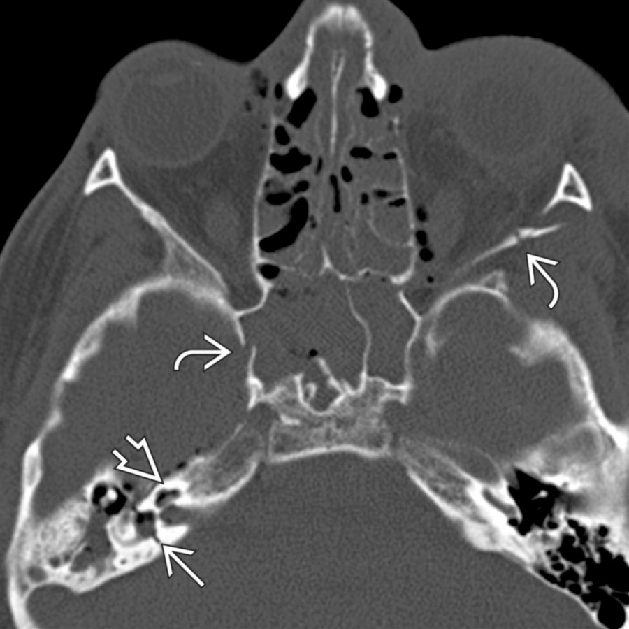 Axial bone CT in a 14 year old involved in a dirt bike accident reveals a horizontal, otic capsule violating right temporal bone fracture crossing the vestibule
. Notice air in the vestibule and cochlea
as well as multiple skull base and orbital fractures
.