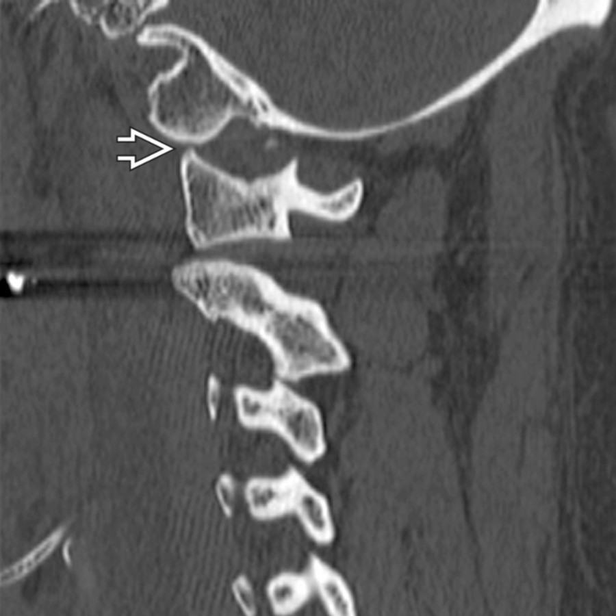 Parasagittal CT shows posterior displacement of the lateral mass of C1 with respect to the occipital condyle
. The normal condyle would be closely applied to the lateral mass of C1.
