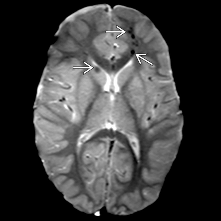 Axial GRE MR in an 4-year-old pedestrian struck by a motor vehicle shows scalp swelling, small ventricles and sulci, and multifocal areas of hemorrhagic shear type injury
.