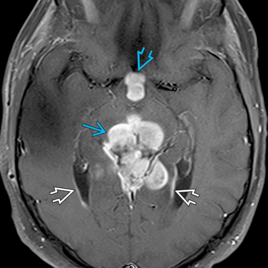 Axial T1 C+ FS MR shows a large enhancing pineal region mass
and an enhancing suprasellar mass
related to a WHO grade 4 pineoblastoma with CSF dissemination. Note the ventricular enhancement
related to ependymal spread.
