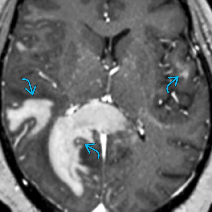 Axial T1 C+ MR in the same patient shows large patchy areas of enhancement
, often called "cloud-like" enhancement. This is one of the most common patterns of enhancement in NMOSD. Other patterns of enhancement include "pencil-thin" periependymal, nodular, and leptomeningeal.