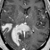 Axial T1 C+ MR in the same patient shows large patchy areas of enhancement
, often called "cloud-like" enhancement. This is one of the most common patterns of enhancement in NMOSD. Other patterns of enhancement include "pencil-thin" periependymal, nodular, and leptomeningeal.