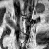 Coronal T1 MR of the lumbar spine in a 67-year-old woman shows an incidental, low-signal left adrenal mass
.