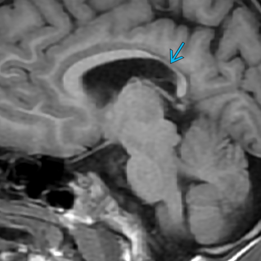 Midline sagittal T1 MR in the same patient shows marked thinning of the posterior body & splenium of the CC
due to WM volume loss. This is the most common area of CC involvement in PVL.