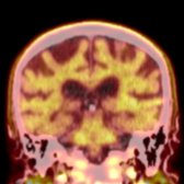 Coronal fusion F-18 florbetapir PET/CT in the same patient shows that activity correlates to remaining brain tissue
, which should not be misinterpreted as gray matter sparing.