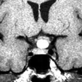 Coronal T1 MR shows a classic Rathke cleft cyst that elevates and drapes the optic chiasm. The pituitary gland is normal.