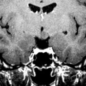 Coronal T1 C+ MR shows a left-sided nonenhancing hamartoma
in the substance of the hypothalamus.