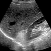 Sagittal US in a 52-year-old woman with right upper quadrant pain shows a subtle, echogenic right suprarenal mass
. Even large myelolipomas may not be perceived on US given their isoechogenicity relative to retroperitoneal fat.