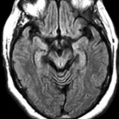 Axial FLAIR MR in the same patient shows the tectal plate is extremely thin
, the lateral aspects of the midbrain are concave
(morning glory sign), and the cerebral peduncles
are atrophic.