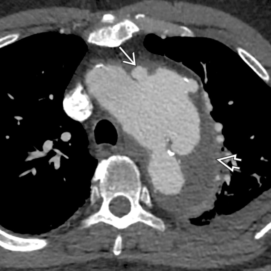 CTA in the same patient shows a large, multilobulated saccular pseudoaneurysm arising from the lateral aspect of the aortic arch
with surrounding soft tissue
, concerning for mycotic aneurysm given the known bacteremia.