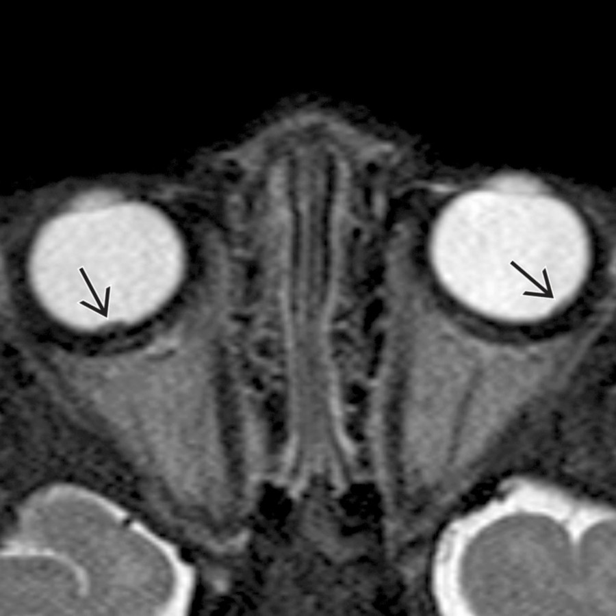 High-resolution axial T2 TSE MR in a 10-month-old girl with TSC shows small, bilateral retinal contour abnormalities
, consistent with retinal hamartomas.