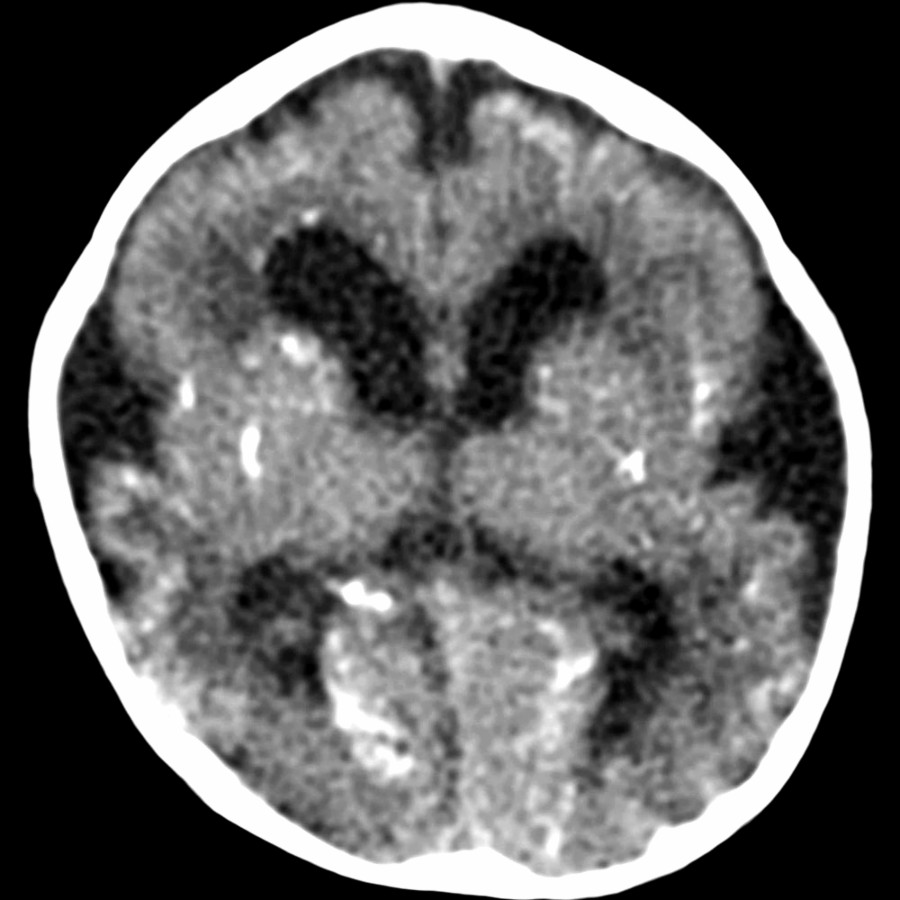 Axial NECT shows periventricular & BG Ca⁺⁺ as well as open Sylvian fissures & ventriculomegaly. Periventricular Ca⁺⁺, ventriculomegaly, & microcephaly strongly suggest congenital CMV infection.