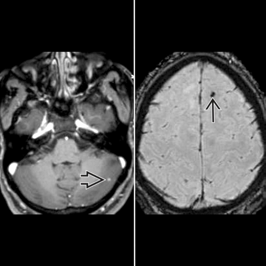 Axial postcontrast MR (left) shows a tiny, solidly enhancing nodule in the left cerebellar hemisphere
due to granular nodular stage of NCC. Axial SWI MR (right) in the same patient shows a blooming hypointense focus in the left frontal lobe
due to nodular calcified stage of NCC.