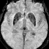 Axial T2* SWI MR demonstrates marked hypointensity in the basal ganglia
related to normal mineralization with age.