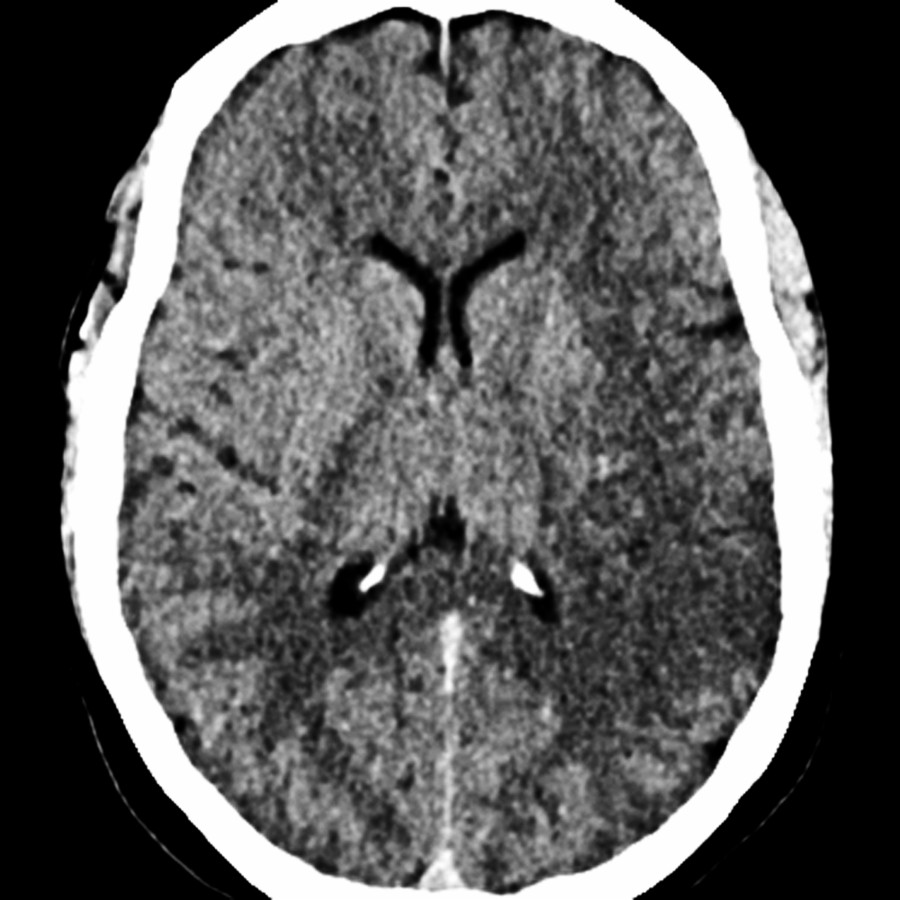 Axial NECT in a 47-year-old woman with sudden onset of right hemiparesis shows hypodensity in the left lateral basal ganglia, insula, and parietal lobe. The total ASPECTS score was 6.