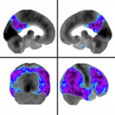 Surface images with quantitative mapping show decreased metabolism in a patient with AD. There is characteristic hypometabolism with sparing of the sensorimotor cortex
. In contrast to LBD, there is significant sparing of the posterior visual areas in the occipital lobe
.