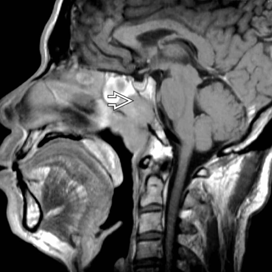Sagittal T1WI MR shows a typical case of an aggressive nasopharyngeal squamous cell carcinoma with invasion of the skull base by direct extension
.