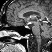 Sagittal T1 C+ FS MR in a middle-aged man who presented with diabetes insipidus shows a slightly thickened infundibular stalk and an infiltrating enhancing lesion in the hypothalamus. Imaging diagnosis was sarcoidosis vs. LH. Biopsy confirmed LH.