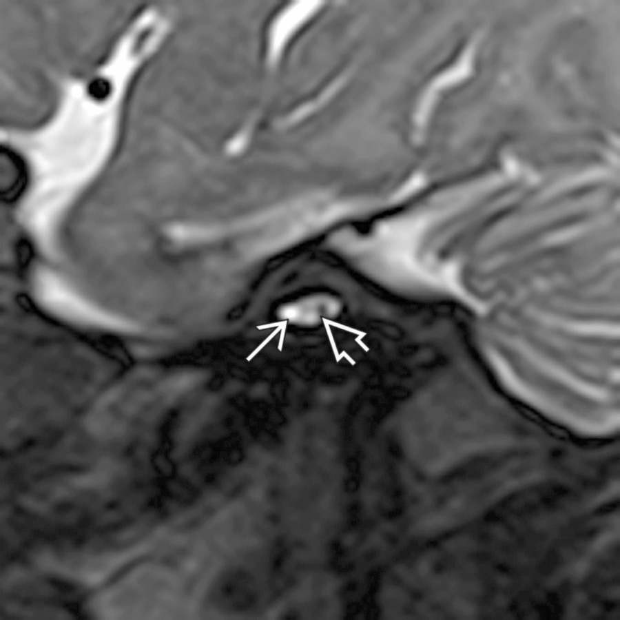 Oblique sagittal T2 SPACE MR in the same child shows a narrow IAC
containing only a single normal-sized cranial nerve (CNVIII vestibular branch)
and a possible hypoplastic CNVII anteriorly.