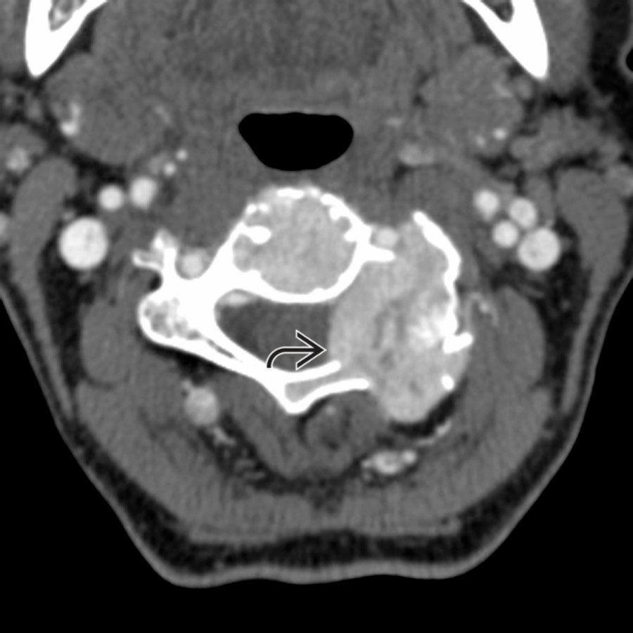 Axial CTA shows the classic appearance of thyroid metastasis with a thin, expansile, bony margin with the predominately lytic lesion within the left facet/lamina of C3
.