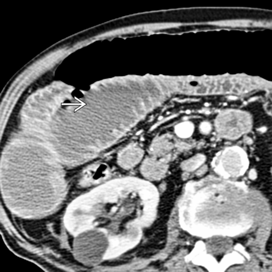 Axial CECT at a higher level in the same patient demonstrates a dilated small bowel
from obstruction.