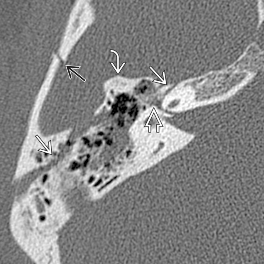 Axial NECT shows a complex temporal bone fracture with a longitudinal component
traversing the anterior genu
of the facial nerve canal and resulting in facial nerve injury. Note a large distracted fragment of the anterior petrous ridge
and temporal squamosal fracture component
.