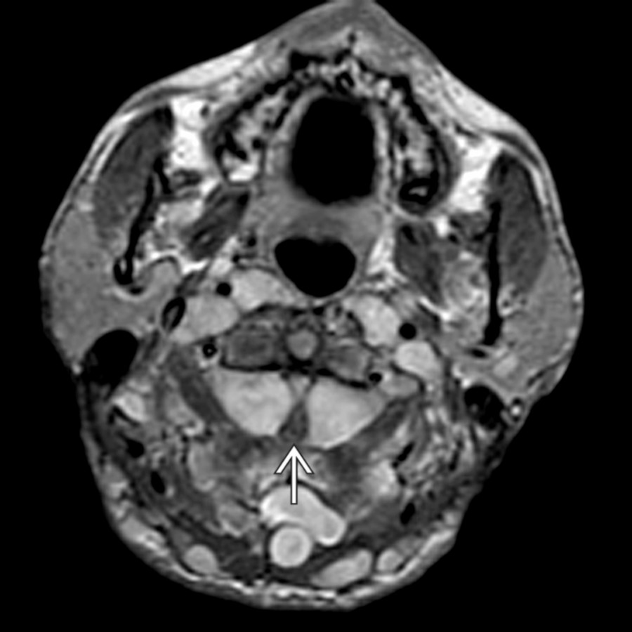 Axial T1WI C+ MR shows multiple large neurofibromas within dorsal soft tissues and paravertebral regions. Symmetrical, large intradural lesions compress the cervical cord
at the C2 level.