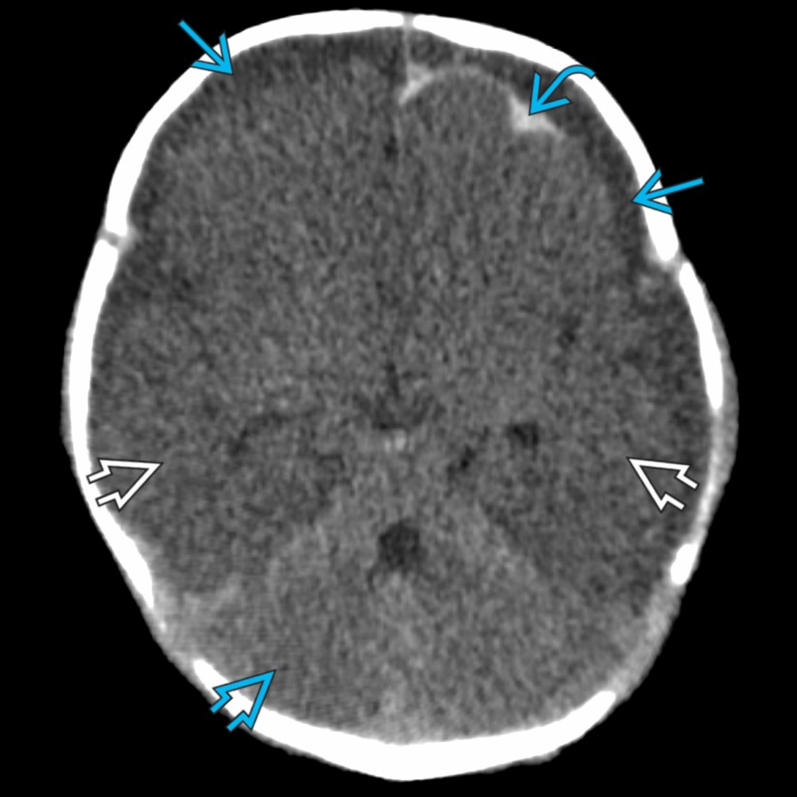 Axial NECT in a 6-week-old with AHT shows hypodense subdural collections
& left frontal arachnoid hemorrhage
. ↓ attenuation throughout the cerebrum
with loss of gray matter-white matter differentiation is consistent with injury. Compare to the normal cerebellum
.