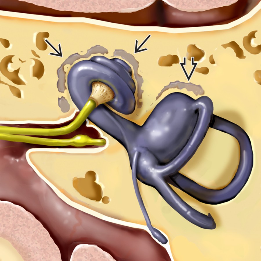 Axial graphic demonstrates a classic example of cochlear otosclerosis. Note otospongiotic plaques in a "halo" around the cochlea
with concurrent fenestral otosclerosis
.