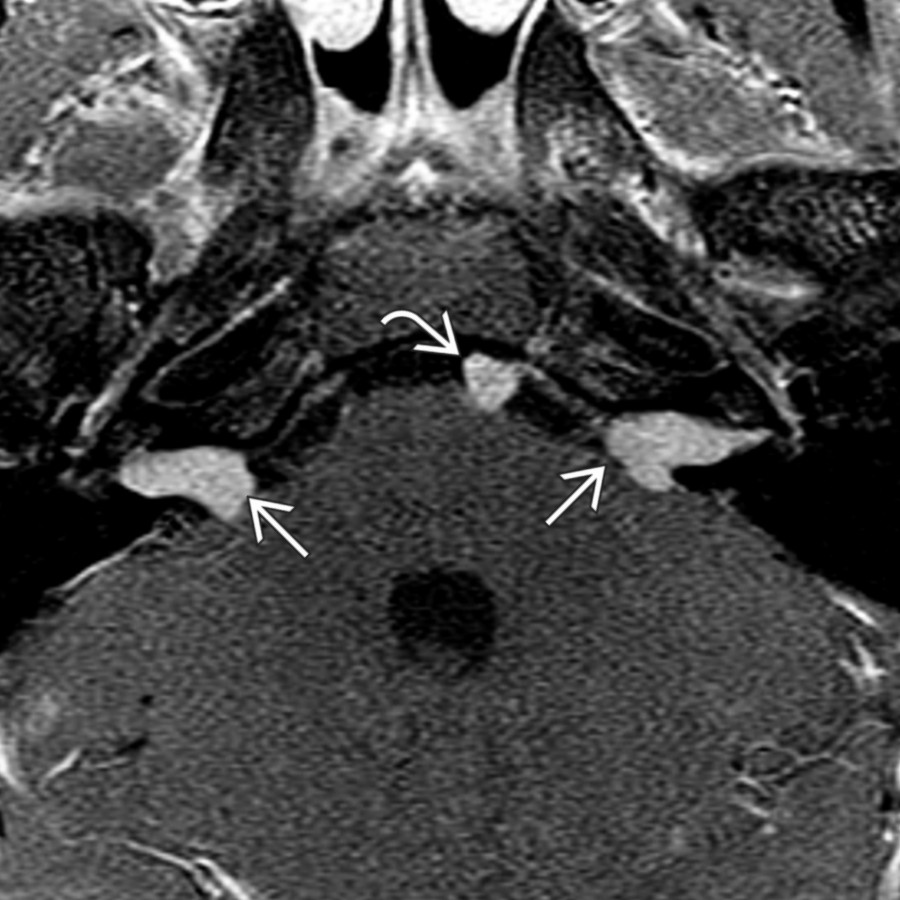 Axial T1 C+ MR in a 12-year-old boy shows bilateral enhancing CPA-IAC masses
and a well-defined, enhancing mass involving the left 6th cranial nerve
, consistent with multiple schwannomas in a child with NF2.
