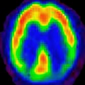 FDG PET in a patient with dementia depicts hypometabolism (green and blue regions in cortex) in both parietal lobes, typical of AD. (Courtesy N. Foster, MD.)