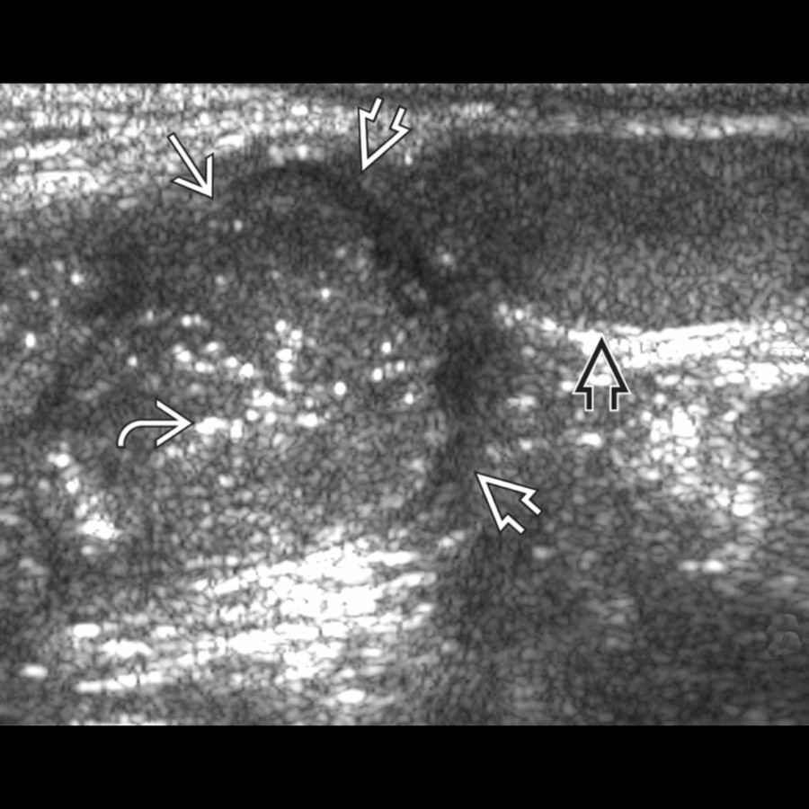 Grayscale ultrasound of the inguinal canal shows bowel loops
herniating into the right inguinal canal
with echogenic foci of gas in the lumen
. Note the relation of the hernia sac to the testis
.