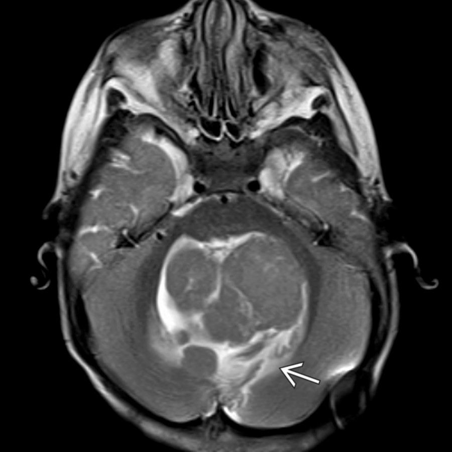 Axial T2 MR in an infant shows an isointense nodular mass within the 4th ventricle with associated cerebellar edema
. This neoplasm demonstrated intense enhancement and decreased diffusion (not shown). This neoplasm was SHH-activated, group 2 medulloblastoma classified histologically as a medulloblastoma with extensive nodularity.