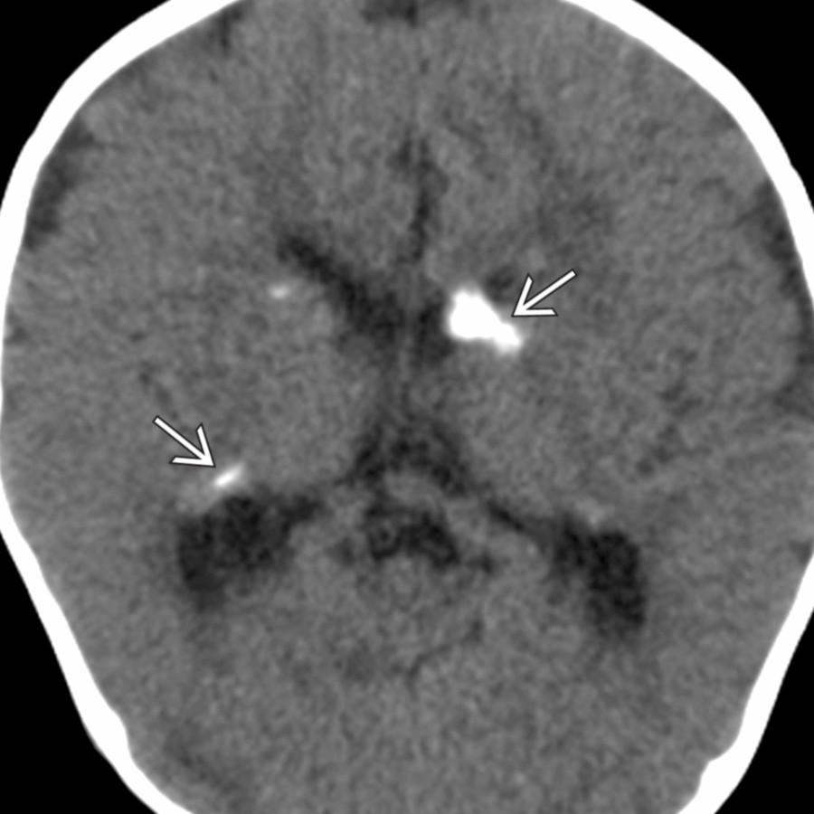 Axial NECT in a 23-month-old girl with TSC shows multiple calcified subependymal nodules
. Note that the location of the nodules adheres to the distribution of fetal germinal matrix with a preponderance in the caudothalamic grooves.