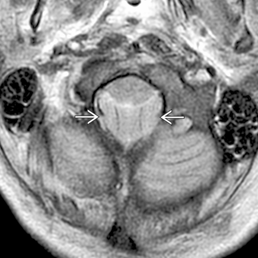 Axial T2WI MR at the level of the foramen magnum demonstrates downward tonsillar herniation
secondary to mass affect from brain death.