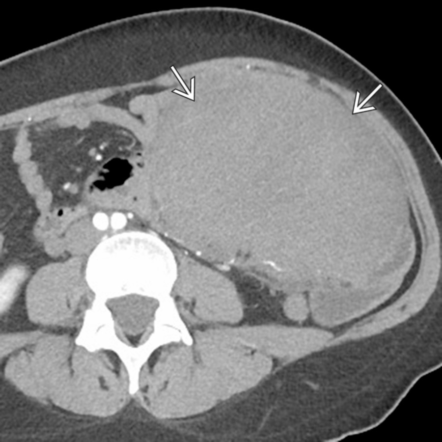 Axial CECT shows a large mesenteric desmoid
with involvement of multiple bowel loops that had been slowly growing on serial examinations. The patient underwent surgical resection, but desmoids with extensive bowel involvement can often be very difficult to resect.