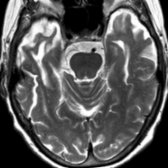 Axial T2WI MR in a 57-year-old woman with probable FTD shows temporal lobe atrophy with knife-like gyri
. The parietal & occipital lobes are relatively well preserved.