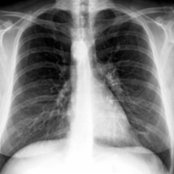 PA chest radiograph in a patient with right aortic arch (RAA) and aberrant left subclavian artery (ALSA) without Kommerell diverticulum (KD) shows RAA
as a right paratracheal nodular opacity with right tracheal indentation.