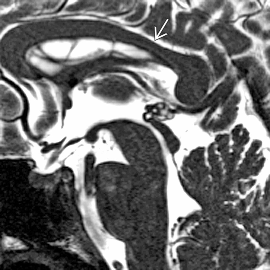 Midline sagittal 3D SSFP MR with a close-up view of the corpus callosum shows normal "wavy" dorsal surface. Note the focal thinning along the posterior body
, a common normal finding.