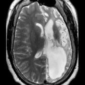 Axial T2 MR in a patient with a remote left MCA infarct shows the typical changes of encephalomalacia & volume loss
. The ipsilateral ventricle is enlarged
.