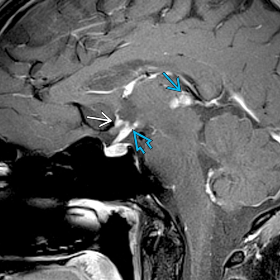 Sagittal T1 C+ MR shows an enhancing pineal mass
with synchronous involvement of the suprasellar region
in this patient who presented with diabetes insipidus. Note additional CSF spread with involvement of the optic recess
of the 3rd ventricle.
