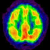 FDG PET in the same patient shows essentially normal glucose metabolism (depicted in red & yellow) in the cerebral cortex, except for small regions of decreased metabolism.