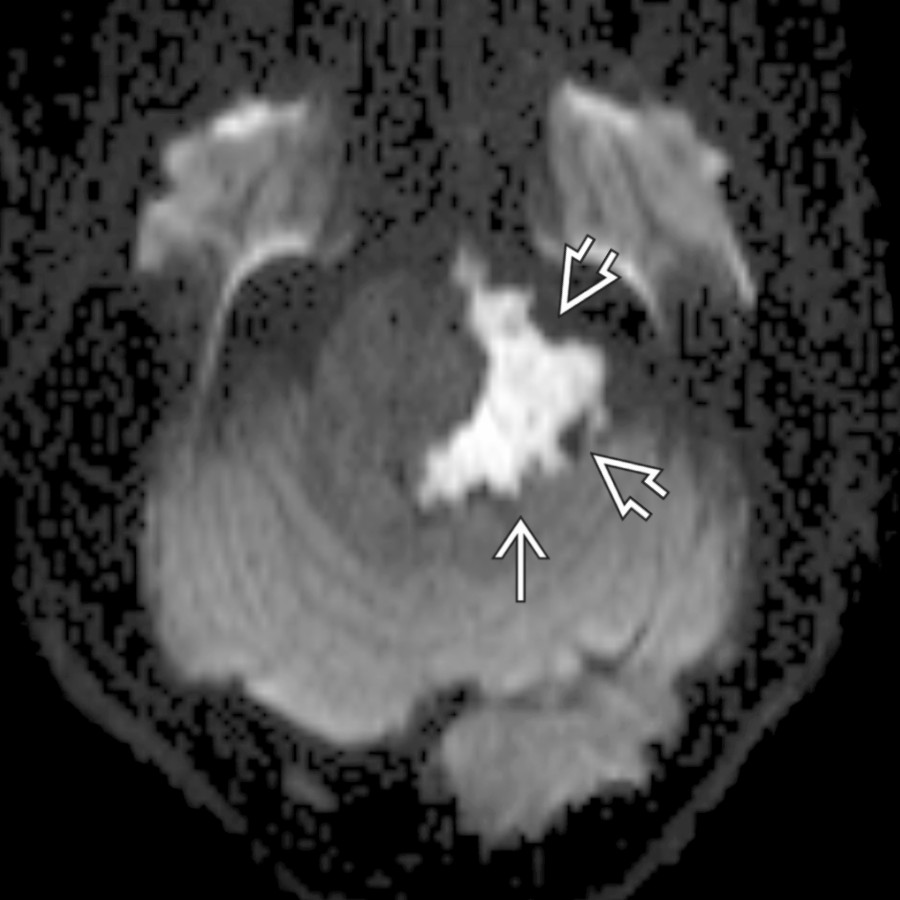 Axial DTI trace image through the posterior fossa shows a typical epidermoid cyst
with reduced diffusivity. Note the scalloped, insinuating margins
, which frequently encase cranial nerves and vessels and can make surgical resection fraught with peril.