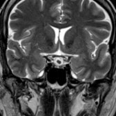Coronal T2 MR in the same patient shows a hyperintense cyst with a hypointense, intracystic nodule
. An intracystic nodule may be seen in up to 75% of Rathke cleft cysts and is a helpful clue to the correct diagnosis.