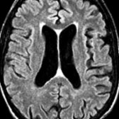 Axial FLAIR MR in an elderly patient shows dilated ventricles, wide cortical sulci, & periventricular white matter hyperintensity.