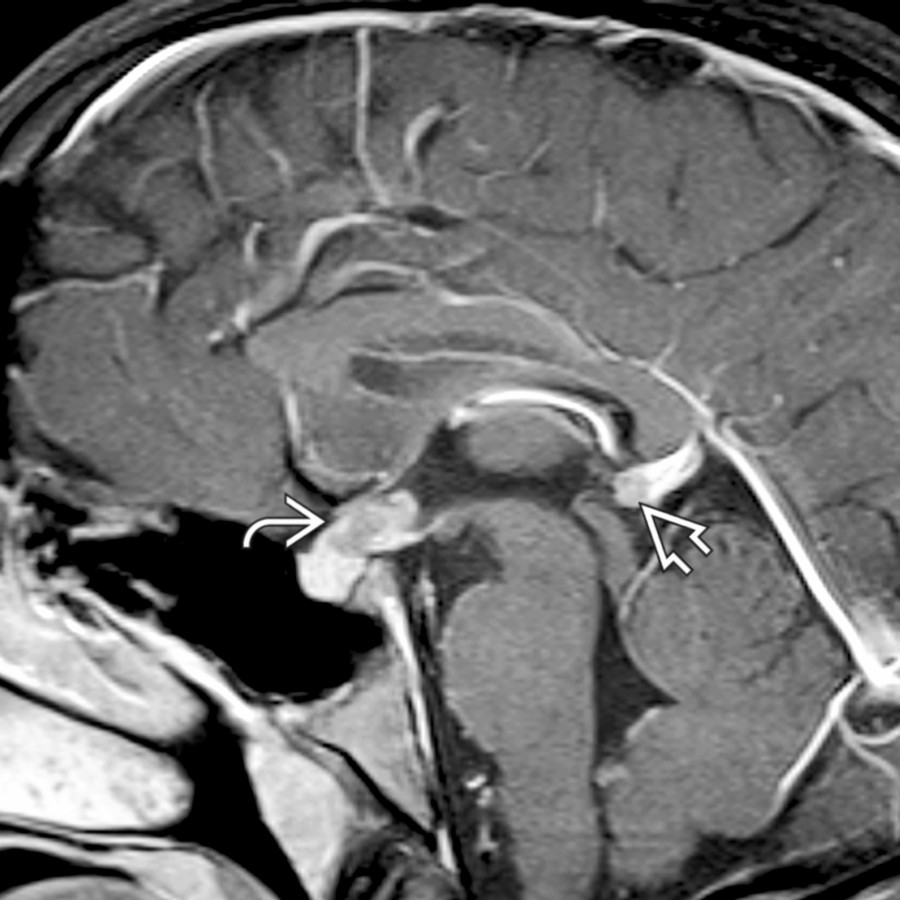 Sagittal T1 C+ MR shows a mildly enhancing suprasellar mass
and a small, synchronous pineal mass
in this patient who presented with diabetes insipidus. The combination of a suprasellar and pineal mass is sometimes called double midline germinoma and occurs in ~ 20% of cases.